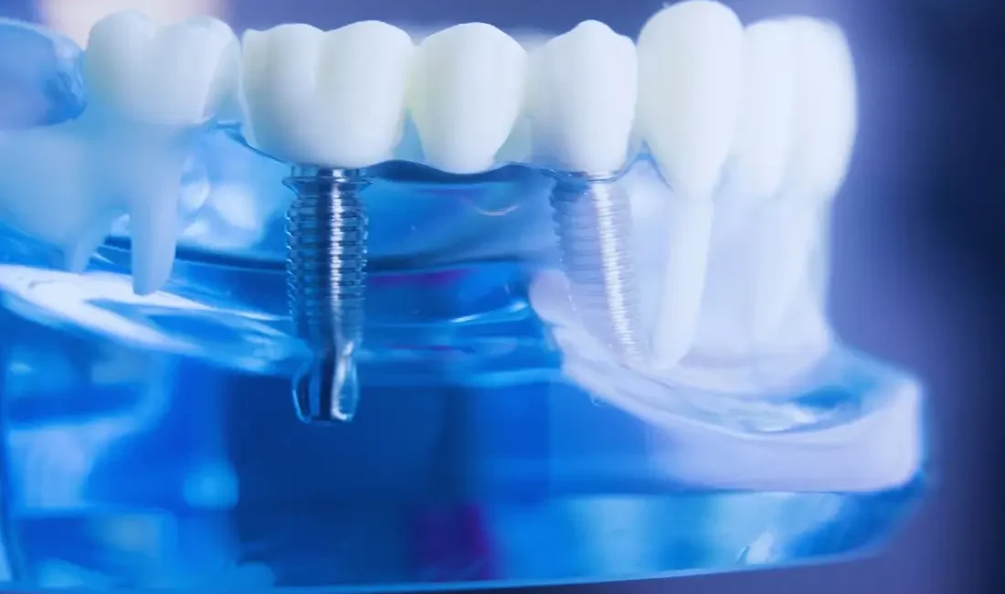 nowoczesna implantologia – implant zęba w szczęce