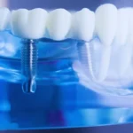 Implantologia – jak implanty zębowe ratują uśmiechy tysięcy ludzi?